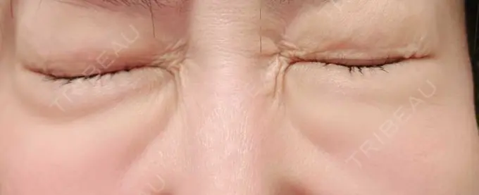 下まぶたの脂肪取り / 脂肪溶解注射（顔） 仙台N美容クリニック BEFORE メイン用