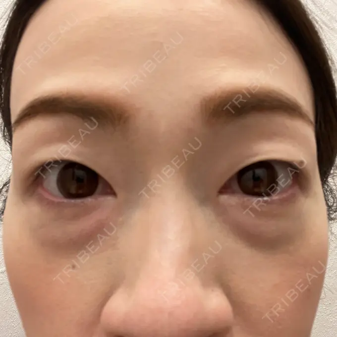 クマ治療 eクリニック 大阪院 BEFORE メイン用