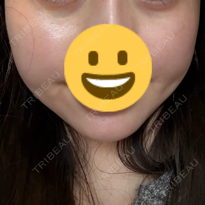 糸リフト / 脂肪吸引（顔） / ヒアルロン酸注入（鼻翼基部） ziz CLINIC BEFORE メイン用