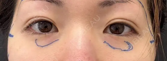 脂肪注入（目の下） eクリニック 福岡院 BEFORE メイン用