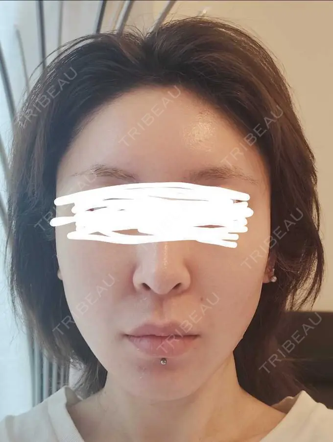 ボトックス（エラ・小顔） / ボトックス（肩） / ボトックス（眉間） / ボトックス（首） Natural Skin Clinic 自由ヶ丘院 BEFORE メイン用