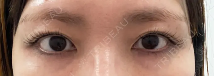 二重埋没 / ヒアルロン酸注入（涙袋） ASTRA BEAUTY CLINIC BEFORE メイン用