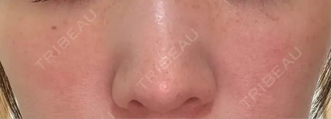 ピーリング（ハリ・ツヤ） / ルメッカ ルラ美容クリニック 仙台院 / ルラスキンクリニック 仙台院 BEFORE メイン用