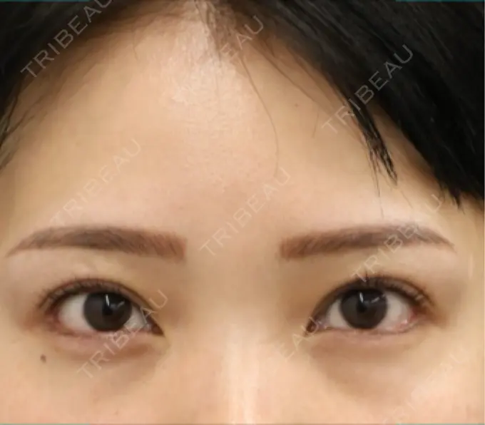 クマ治療 BELLMONA CLINIC BEFORE メイン用