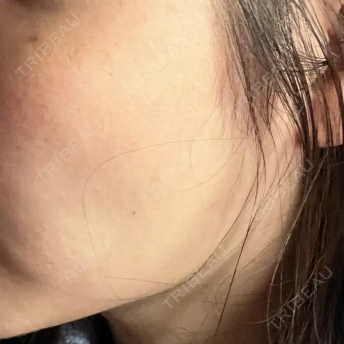 ボトックス（エラ・小顔） TCB東京中央美容外科 浜松院 BEFORE メイン用