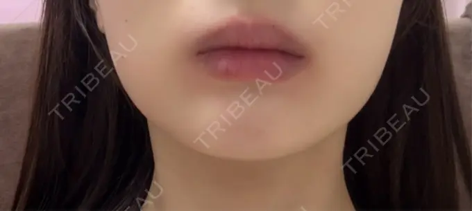 セットバック / ヒアルロン酸注入（唇） / ボトックス（口角） フィラークリニック 大阪梅田院 BEFORE メイン用