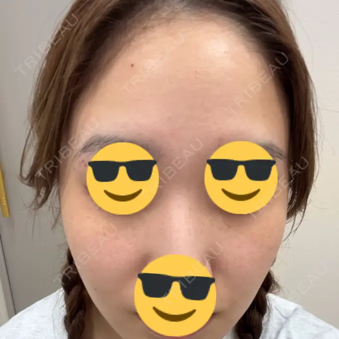 ピーリング（ハリ・ツヤ） / ルメッカ PureMe Skin Clinic（ピュアミースキンクリニック麻布） BEFORE メイン用