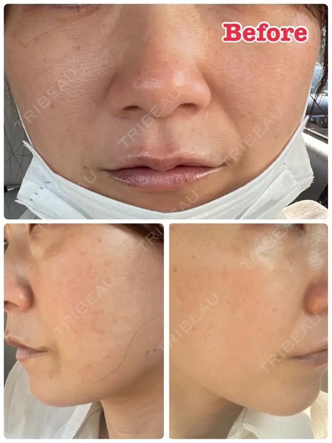 ピーリング（ハリ・ツヤ） / ルメッカ ルラ美容クリニック 名古屋本院 BEFORE メイン用