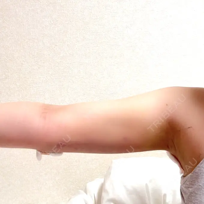 脂肪吸引（二の腕） / 脂肪吸引（肩） THE CLINIC（ザ・クリニック） 福岡院 BEFORE メイン用