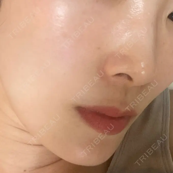 イオン導入 / ピーリング（ハリ・ツヤ） ルラ美容クリニック 名古屋本院 BEFORE メイン用