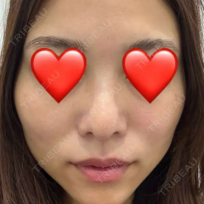 ボトックス（肩） / 肌育注射（ジュベルックなど） APスキンクリニック銀座 BEFORE メイン用