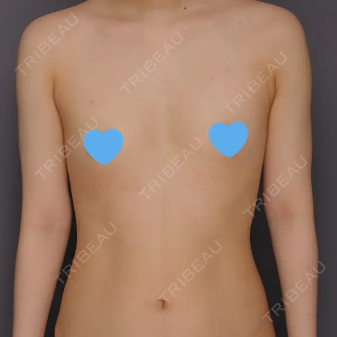 脂肪吸引（脚） / 豊胸（シリコン＋脂肪併用） 札幌ル・トロワ ビューティクリニックVogue BEFORE メイン用