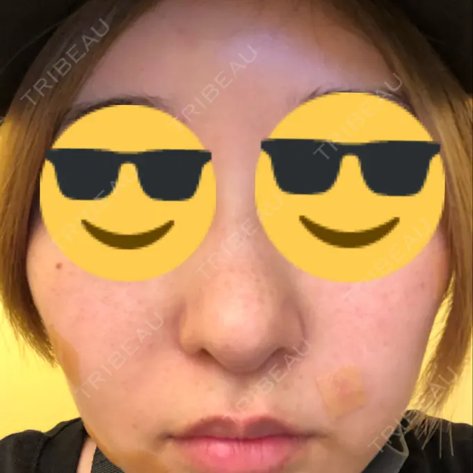 隆鼻術 / 軟骨移植 / 骨切幅寄せ / 鼻尖縮小 / その他（鼻） 韓国BBクリニック（旧 シンミアン形成外科） BEFORE メイン用