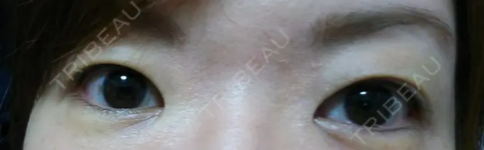 二重埋没 ガーデンクリニック 名古屋院 BEFORE メイン用