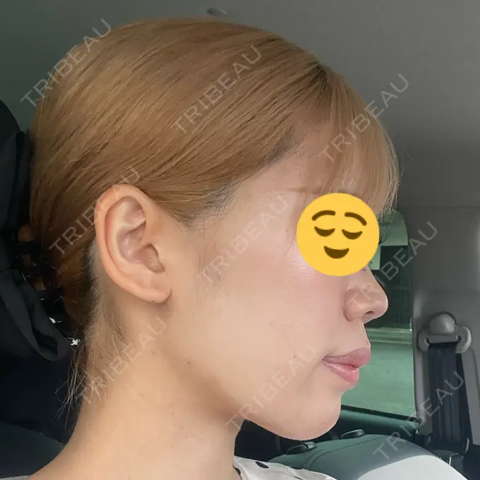 ヒアルロン酸注入（額） / ボトックス（肩） / ヒアルロン酸注入（こめかみ） / ヒアルロン酸注入（鼻翼基部） BITO BEAUTY CLINIC BEFORE メイン用