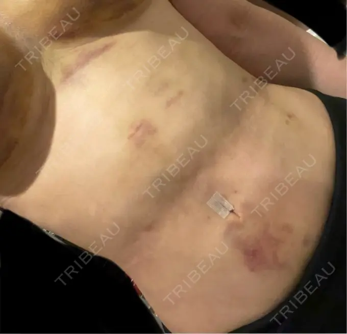 インディバ（お腹） / インディバ（脚） / インディバ（腰） / インディバ（背中） WOM SALON【術後ケア取扱いサロン】 BEFORE メイン用