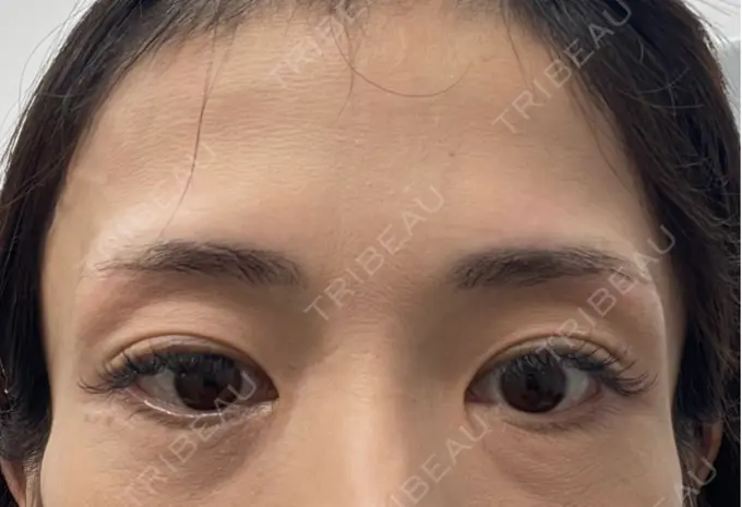 アートメイク（眉） 湘南AGAクリニック 大阪院 BEFORE メイン用