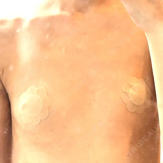 豊胸（シリコンバッグ） ルーチェクリニック 銀座院 BEFORE メイン用