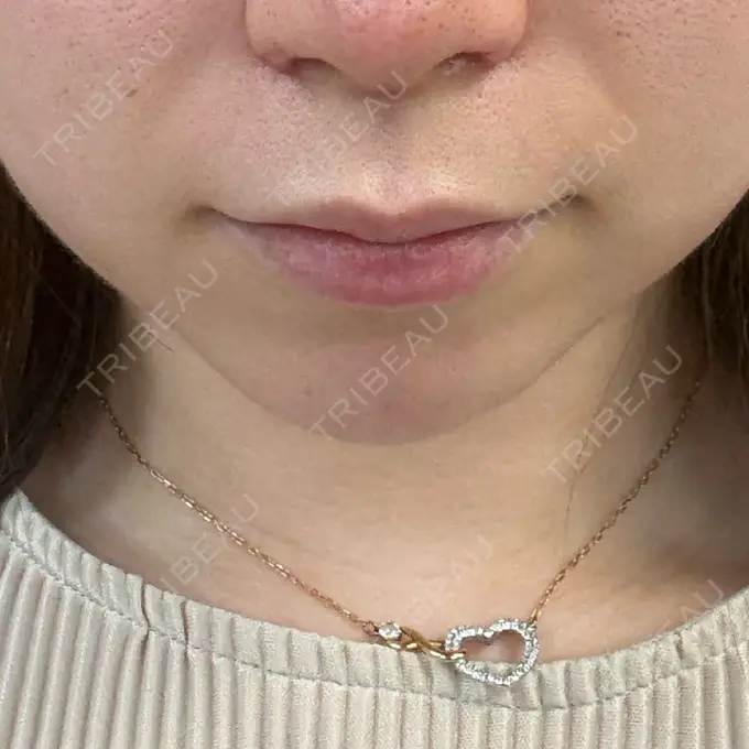 ヒアルロン酸注入（あご） ルラ美容クリニック 渋谷本院 BEFORE メイン用