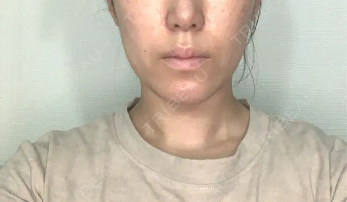 ボトックス（エラ・小顔） TCB東京中央美容外科 立川院 BEFORE メイン用