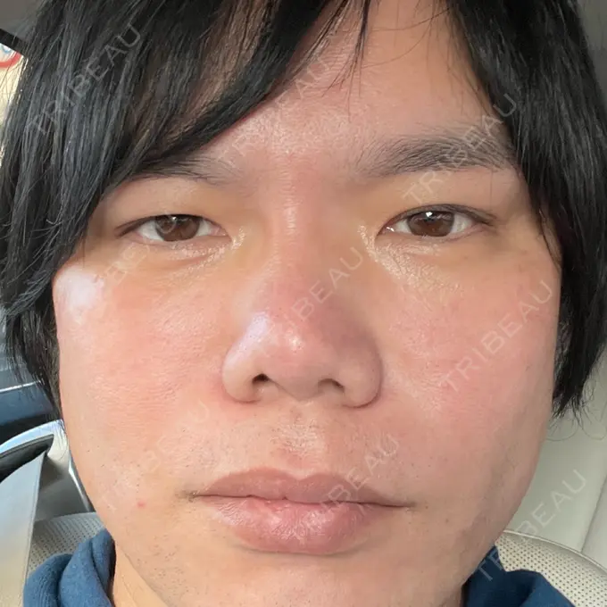 斜鼻修正 / 切開リフト / 眼瞼下垂（非切開） id（アイディ）美容外科 BEFORE メイン用