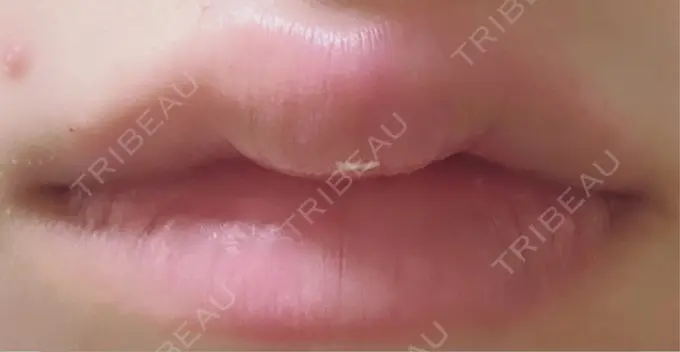 ヒアルロン酸注入（唇） MKクリニック 日本橋院 BEFORE メイン用