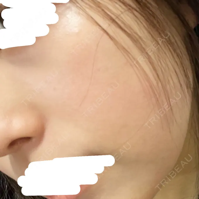 エレクトロポレーション / ルメッカ ウィルビークリニック 新宿院 BEFORE メイン用