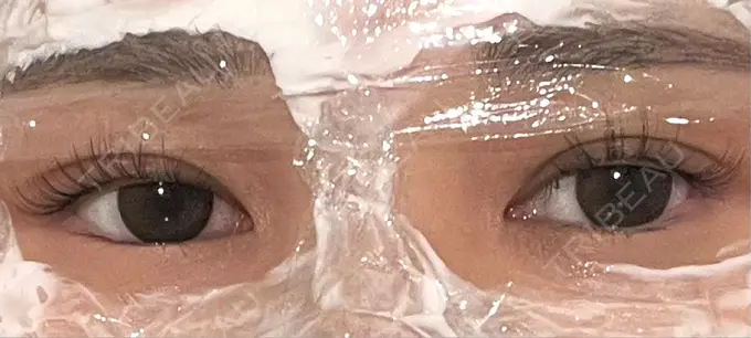 ヒアルロン酸注入（涙袋） / ワキ汗治療（ボトックス） / ボトックス（額） / ボトックス（人中） ルヴィクリニック イオンドーム前院 BEFORE メイン用