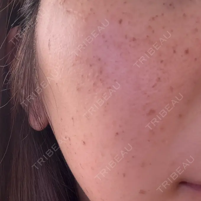 イオン導入 / ピーリング（ハリ・ツヤ） / ルメッカ ルラ美容クリニック 名古屋本院 BEFORE メイン用