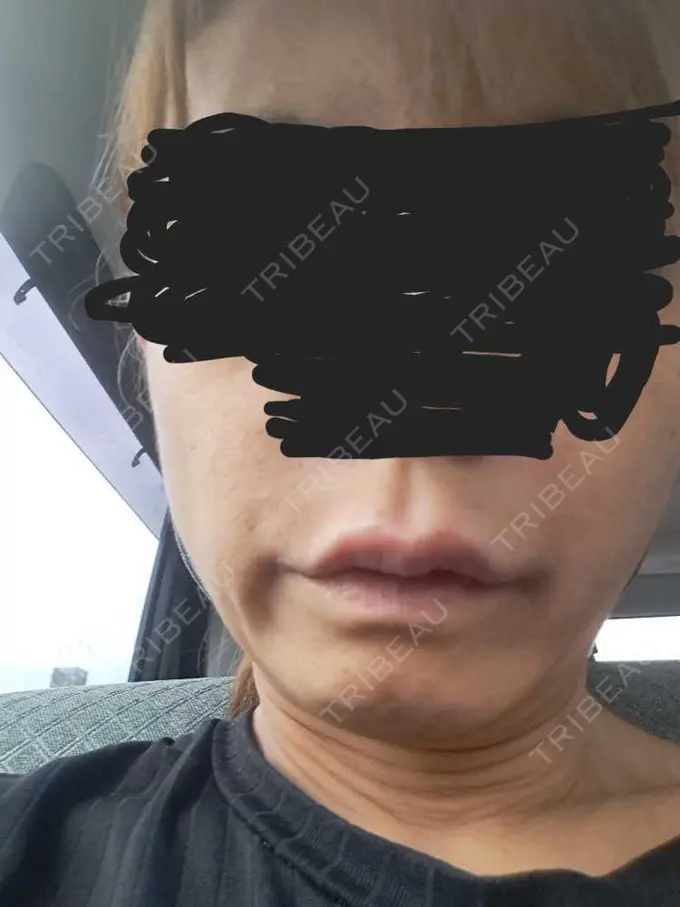 ヒアルロン酸注入（唇） / ボトックス（口角） / ボトックス（眉間） / ボトックス（額） ルラ美容クリニック 広島院 BEFORE メイン用