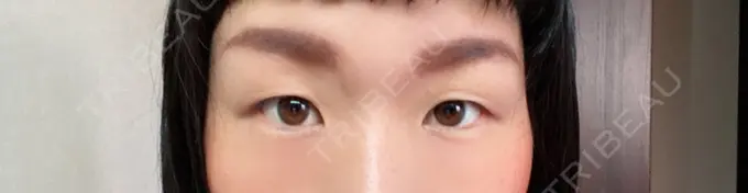 二重埋没 湘南美容クリニック 京都院 BEFORE メイン用