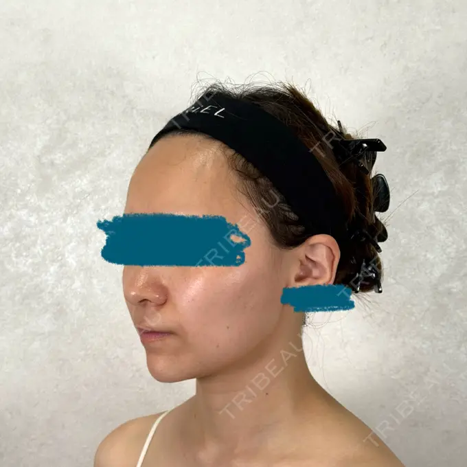 糸リフト / シワ取りボトックス / ボトックス（眉間） アリエル美容クリニック 横浜院 BEFORE メイン用