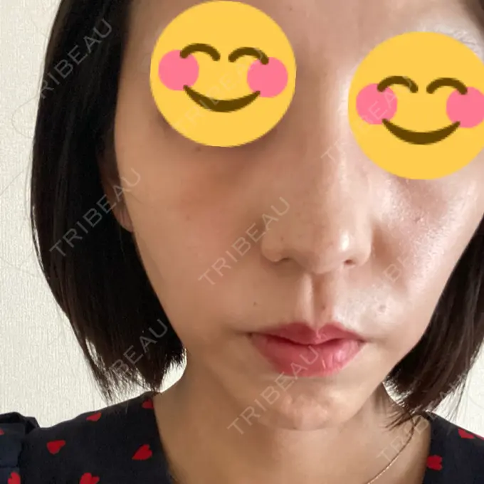 光治療（フォトフェイシャルなど） ミニマムスキンクリニック池袋 BEFORE メイン用