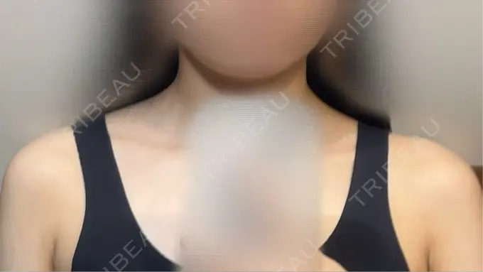 ボトックス（肩） ヴァージンクリニック 福岡天神院 BEFORE メイン用