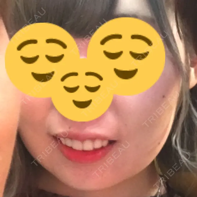 ボトックス（あご） / ヒアルロン酸注入（額） / ハイフ（顔） 湘南美容クリニック 長野院 BEFORE メイン用