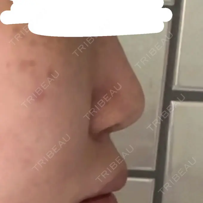 隆鼻術 / 鼻尖形成（切開） / 鼻中隔延長（切開） / 糸リフト / 脂肪吸引（顔） / 鼻尖縮小 / 脂肪冷却（輪郭） ジョウクリニック 那覇院 BEFORE メイン用