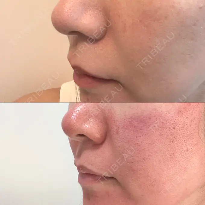 ダーマペン DAILY SKIN CLINIC 福岡院 BEFORE メイン用