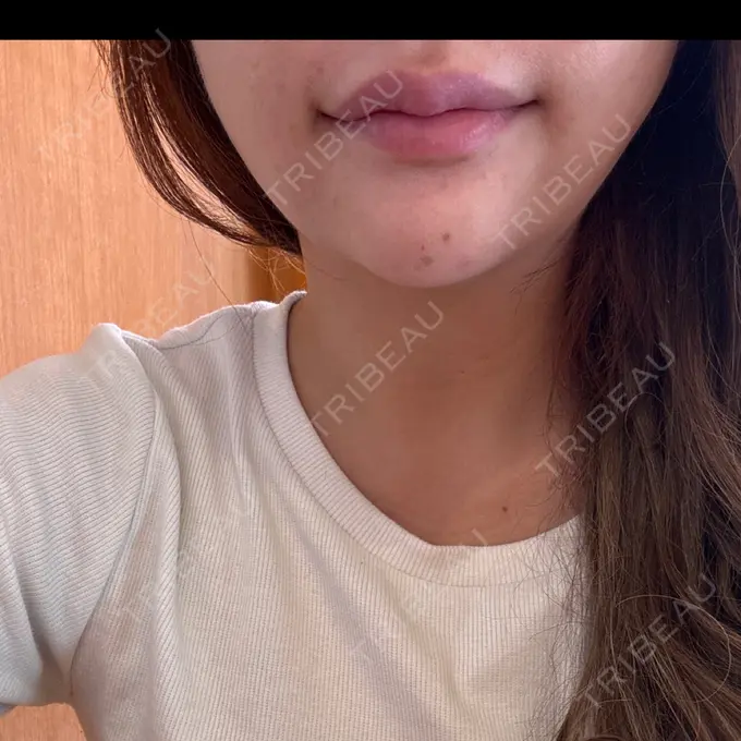 ヒアルロン酸注入（あご） / ボトックス（エラ・小顔） TCB東京中央美容外科 新宿東口院 BEFORE メイン用