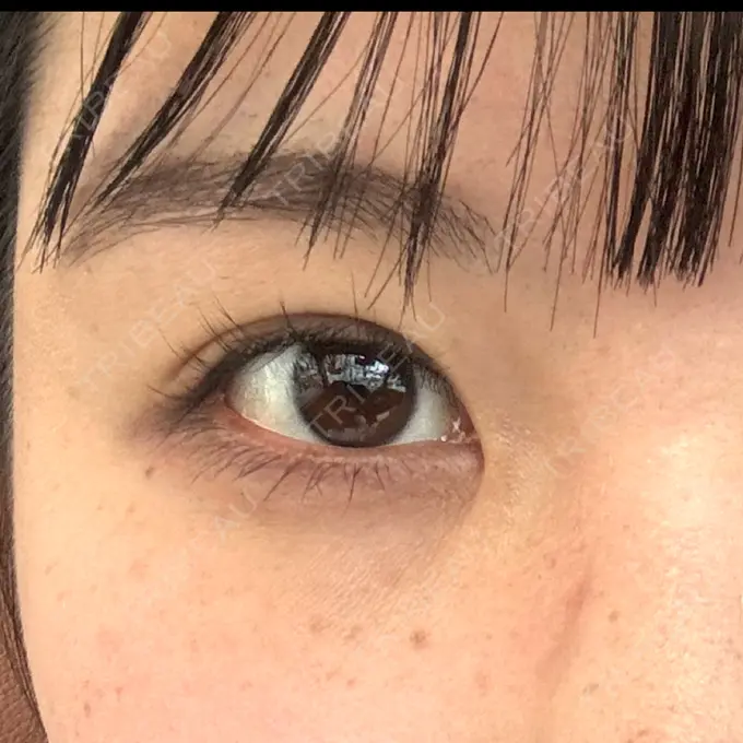 ヒアルロン酸注入（涙袋） 共立美容外科 熊本院 BEFORE メイン用