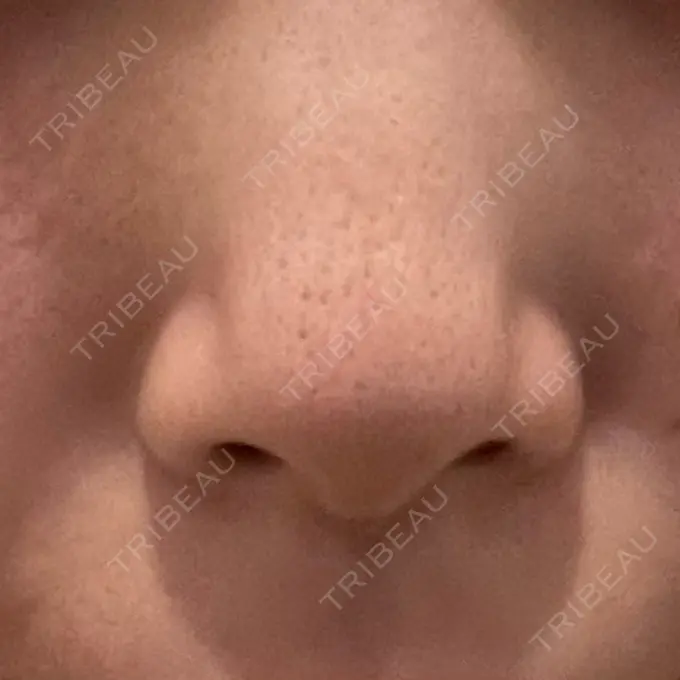 ピーリング（ニキビ・毛穴） / LED治療 東京素肌クリニック 新宿院 BEFORE メイン用