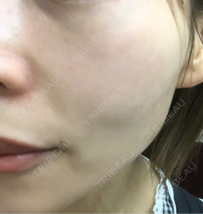 ピコレーザートーニング（美白・肝斑） / ピコフラクショナルレーザー（毛穴・ニキビ跡） APスキンクリニック銀座 BEFORE メイン用