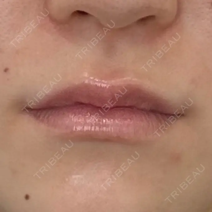 ヒアルロン酸注入（唇） 新未来クリニック BEFORE メイン用