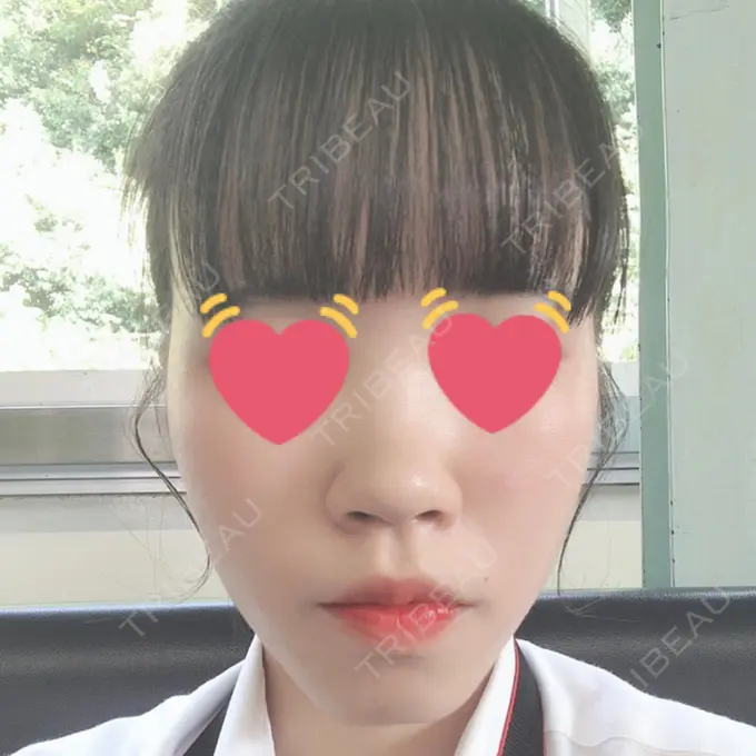 鼻尖縮小 / ヒアルロン酸注入（鼻） 東京ヒルズクリニック 岡崎院 BEFORE メイン用