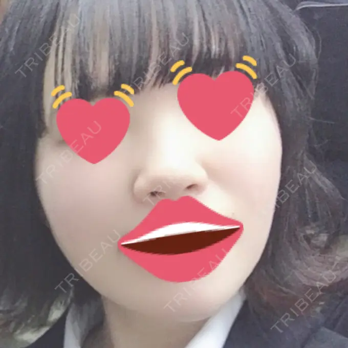 ヒアルロン酸注入（鼻） 東京ヒルズクリニック 岡崎院 BEFORE メイン用