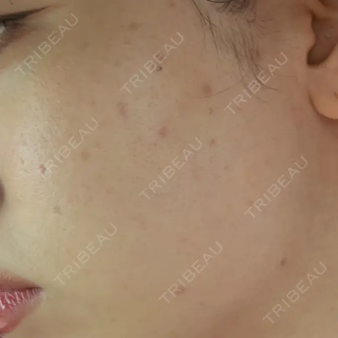 エレクトロポレーション / ルメッカ Grias clinic （ジリアスクリニック） BEFORE メイン用