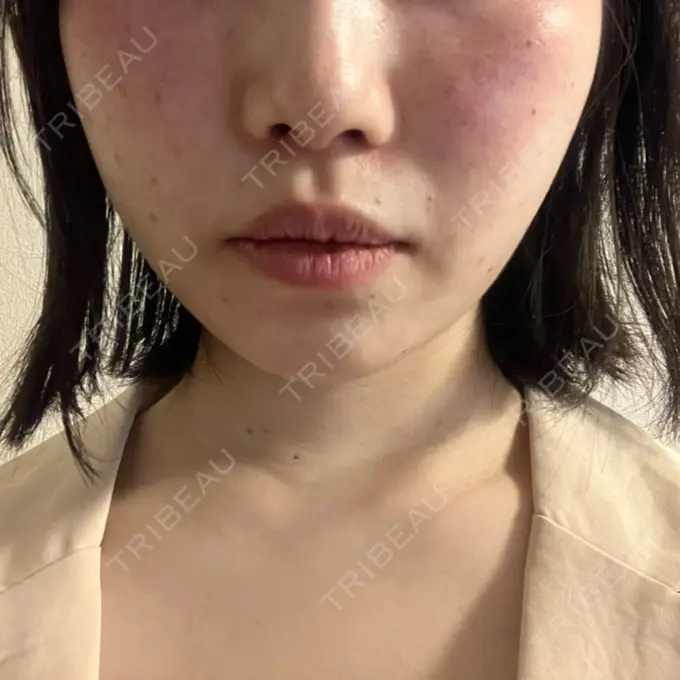 ルビーレーザー Designo Clinic （デジーノクリニック） BEFORE メイン用