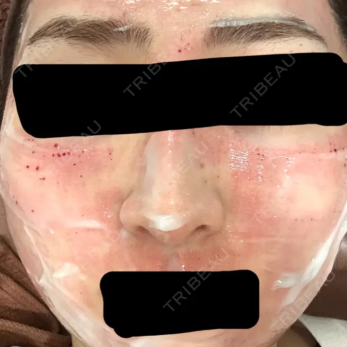 毛穴洗浄（ハイドラフェイシャルなど） / リジュラン / ポテンツァ ミケイ医院 BEFORE メイン用