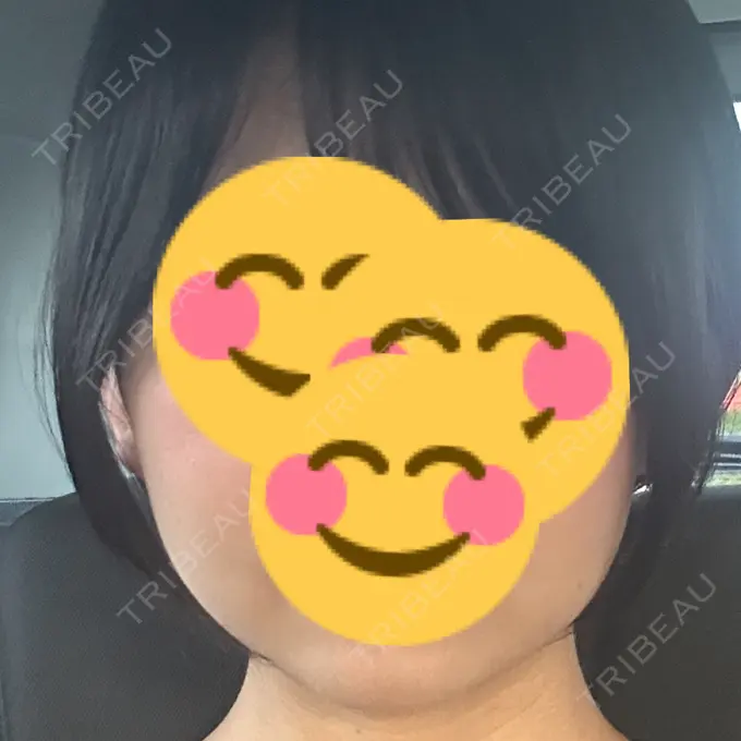 その他（肌） / RF（高周波）たるみ治療 / その他（輪郭） ルラ美容クリニック 仙台院 / ルラスキンクリニック 仙台院 BEFORE メイン用