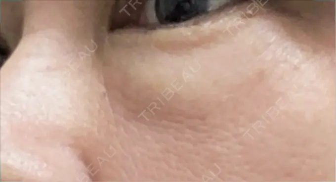 下まぶたの脂肪取り 博多もへじのクリニック BEFORE メイン用