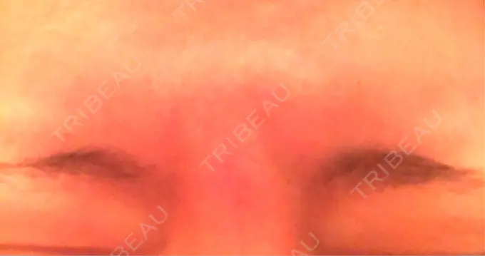 ボトックス（眉間） 湘南美容クリニック 名古屋栄院 BEFORE メイン用